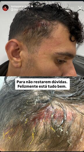 Tomás Araújo mostra corte na cabeça