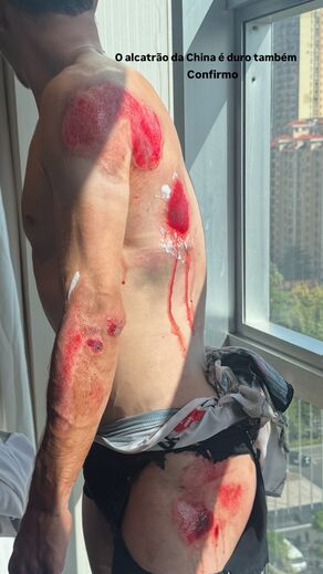 Rui Oliveira mostra ferimentos após queda na China