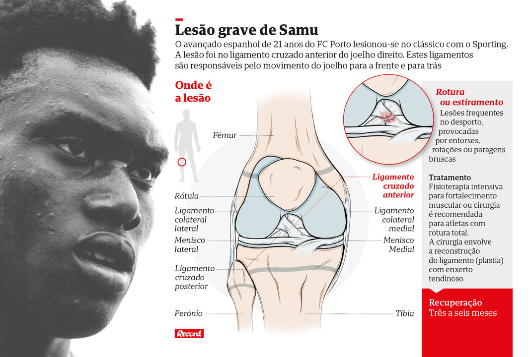 Lesão de Samu à lupa
