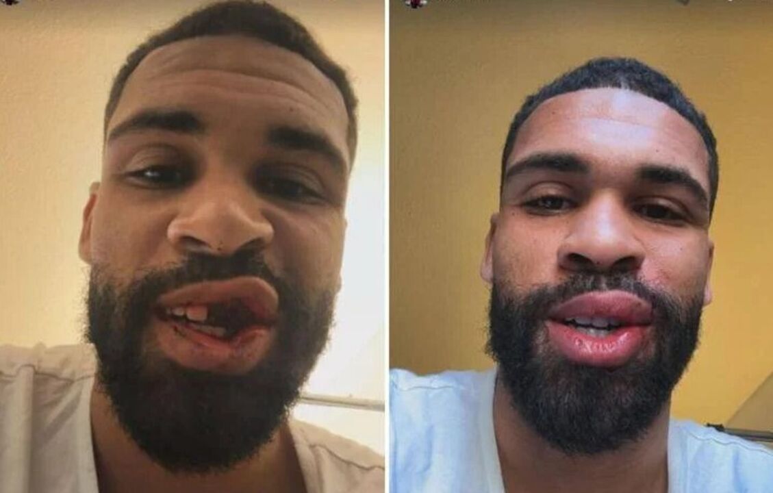 Loftus-Cheek operado após fratura no maxilar em jogo do Milan com o Parma