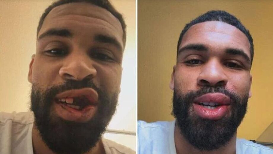 Loftus-Cheek operado após fratura no maxilar em jogo do Milan com o Parma