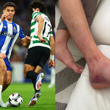 <![CDATA[ Assim ficou Hjulmand após o pisão de Gabri Veiga: pé direito do capitão do Sporting negro e inchado ]]>