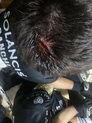 Jogador do HC Turquel com ferimento na cabeça após jogo com o CD Póvoa